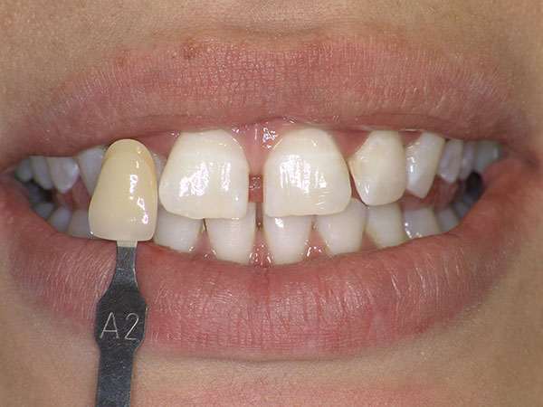 Λεύκανση Δοντιών Denta